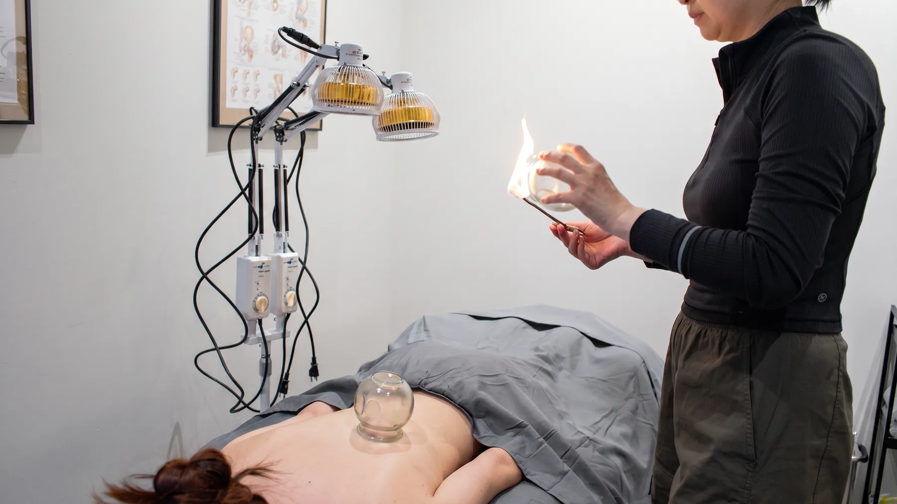 Fire cupping applied to a patient's back at Fittopia Wellness Studio.